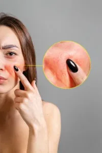 bigstock the concept of rosacea a cauc 344876344