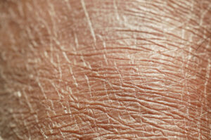 Closeup view of dry human skin